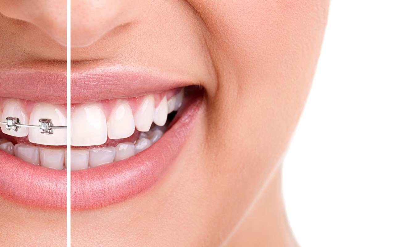 Выравнивание зубов у ортодонта