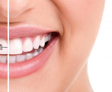 Выравнивание зубов у ортодонта