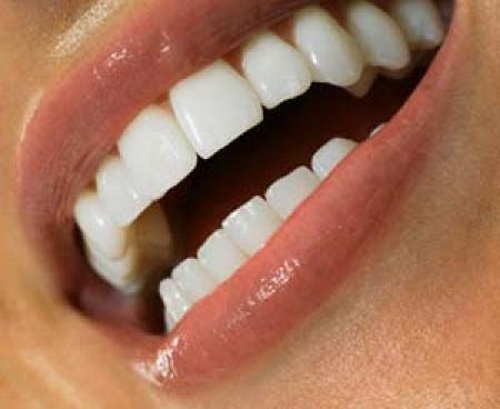 Средства, применяемые для домашнего отбеливания зубов