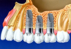 Дентальная имплантация зубов: преимущества и недостатки