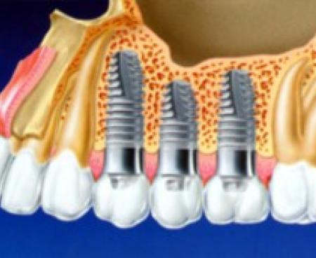 Дентальная имплантация зубов: преимущества и недостатки